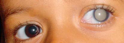 The most common eye cancer in children is retinoblastoma, which starts in the cells of the retina. Cancer in the Eyes - Causes, Symptoms and Treatment