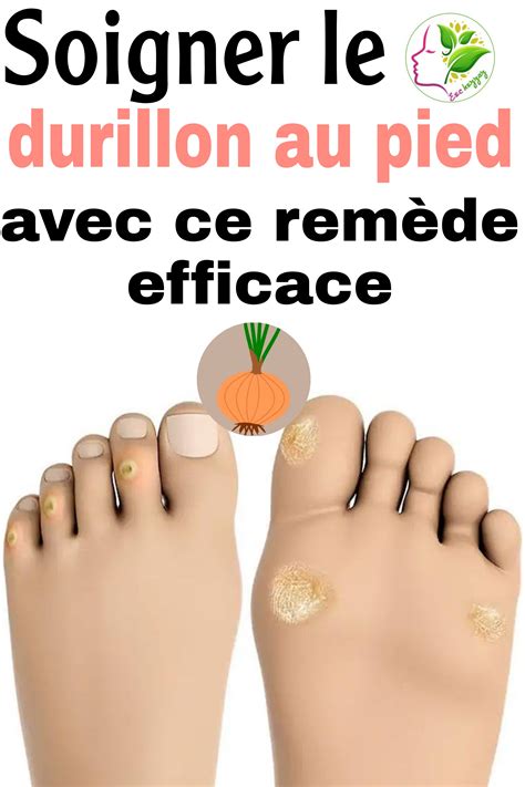 Enlever le durillon sous le pied avec ce remède maison