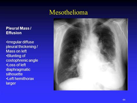 The mesothelioma treatment that uses ttf is for patients whose mesothelioma is unresectable, locally advanced, or metastatic. Pleural Mesothelioma Ppt