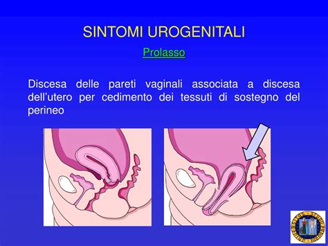 PPT - Menopausa, HRT Mastopatia fibrocistica, mastiti e ...