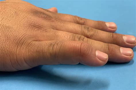 Mallet Finger - Hand Therapy Group