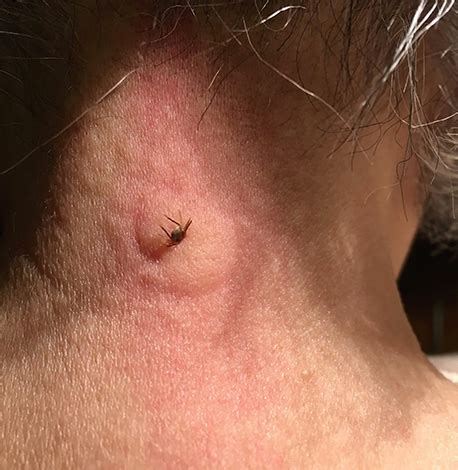 Cosa fare se morso da una zecca: aiutare una persona a casa