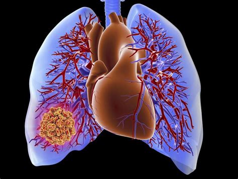 Hi, this is possible if the embolism occurs along the periphery. D-Dimer Shows Promise for Pulmonary Embolism Diagnosis in ...