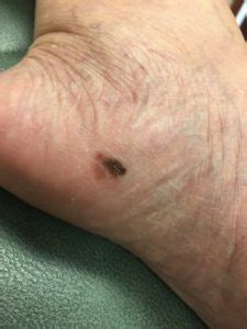 Chondromas affects tubular bones of the hands and feet in 50% of cases, and it is also seen in the femur, humerus, and ribs. What We Need to Know About Skin Cancer of the Feet