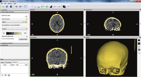 Disponível para as plataformas microsoft windows. Skull stripping in InVesalius medical image program ...