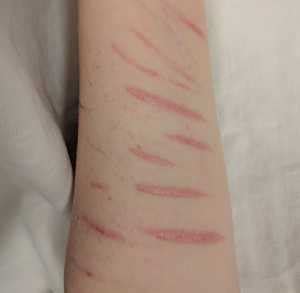 One common method is cutting with a sharp object. MedicalResearch.com | self-harm-wikipedia