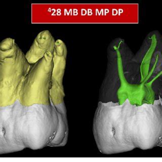 There is a large cervical resorptive defect on the buccal aspect of the distal root extending into the furcation. Application of the new coding system to describe teeth ...