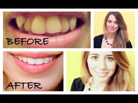 After exploring the gallery, we invite you to get in touch to learn more about your treatment options. MY INVISALIGN experience - Before & After - YouTube