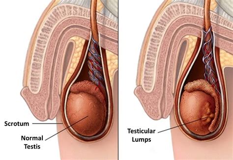 Symptoms may include a lump in the testicle, or swelling or pain in the scrotum. Testicular Cancer In men - http://www.knowledge.com.sg