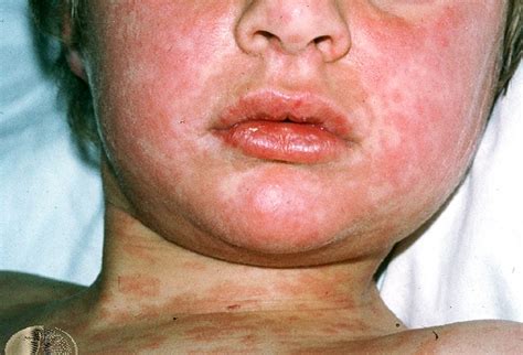 Maybe you would like to learn more about one of these? Measles: The Real Evidence
