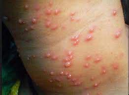 Dan area yang lazim terkena bintik merah pada kulit disertai gatal adalah; Apa Obat Untuk Gatal Gatal Disertai Benjolan Bernanah ...