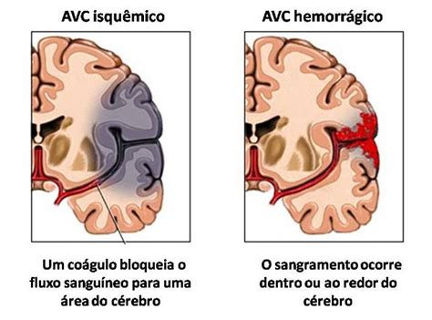 Un vaso sanguíneo se bloquea con un interpretación emocional de la falta de riego o isquemia cerebral. Fisioblogando: Acidente Vascular Cerebral (AVC)