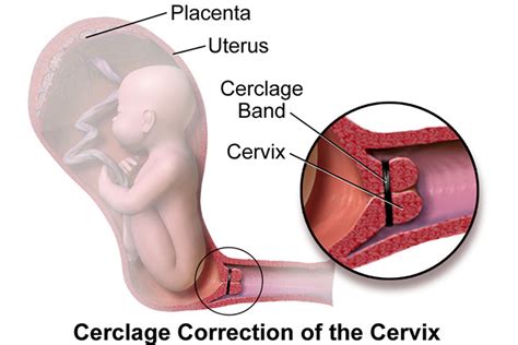 A foetus is an animal or human being in its later stages of development before it is. Cervical Cerclage: Warum und wie wird es während der ...