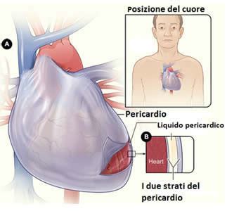 Non esiste un test definitivo per confermare la malattia, bensì la una diagnosi è prevalentemente clinica. Pericardite