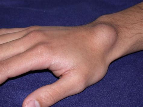 The conventional medical view of ganglion cysts is that they are idiopathic, meaning that definitive causes are not known. Ganglion cyst of hand and wrist treatment by Raleigh Hand ...