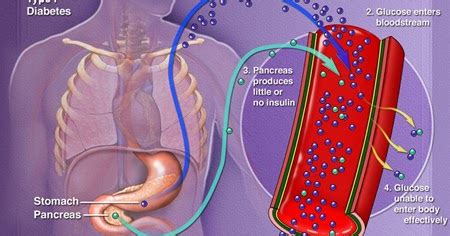 Carbohydrates are the sugars, starches and fibers found in fruits, grains, vegetables and milk products. Type 1 Diabetes Mellitus (1DDM) ~ DIABETES MELLITUS