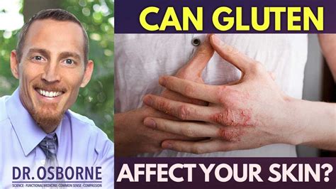 Check spelling or type a new query. Does Gluten Cause Skin Problems? - YouTube