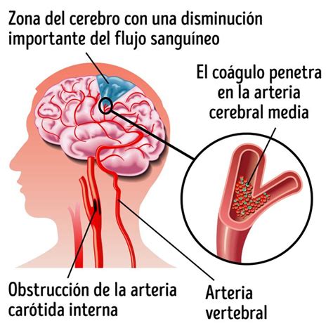 Además, desde los años setenta del siglo pasado, el problema se ha agudizado con la generalización de técnicas como. Lo que necesitas saber sobre un derrame cerebral silencioso: tercera causa de muerte súbita en ...