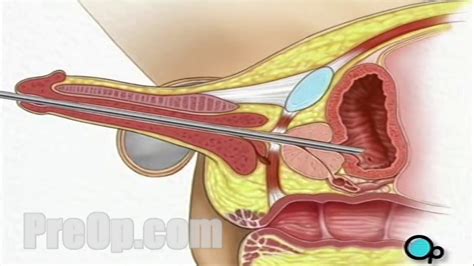 In other cases, counselling or pelvic floor. Cystoscopy Male via Penis Surgery - Patient Education ...