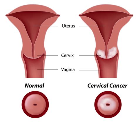 If cervical cancer is diagnosed, relieving symptoms remains an important part of cancer care and treatment. Cervical Cancer Awareness Month 2013