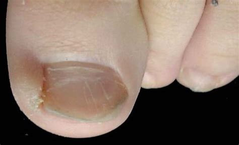 This ingredient is included in a lot of ingrown hair products, but those with sensitive skin should be wary of its effects. ingrown nail, dermatologist specialized in nail disease ...