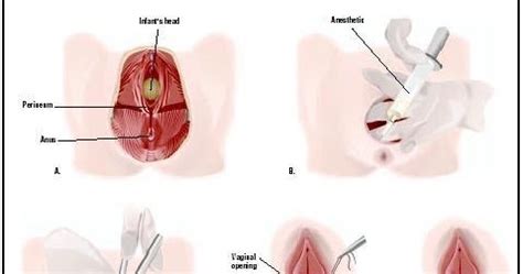 Lanakeloid adalah salah satu salep antibiotik untuk luka jahitan yang seringkali digunakan oleh dokter pada pasiennya. Arifa.Salleh: Jahitan bersalin terbuka ...perlu jahit ...