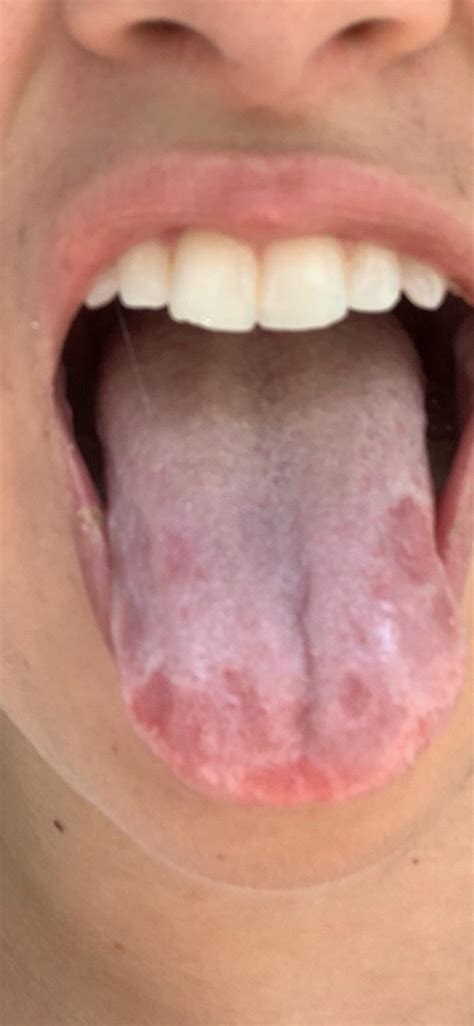 Glossodynia (burning tongue syndrome, also called glossopyrosis) is another possible cause for a swollen or spotted tongue. Weird spots on tongue and burns like I ate something spicy ...