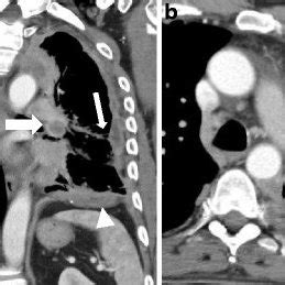 Check spelling or type a new query. Biphasic mesothelioma; chest X-ray film (a) showing a ...