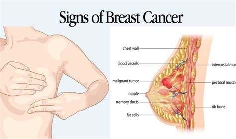 Inflammatory breast cancer tends to occur at a younger age than other types of cancer. What are the Early Symptoms & Signs of Breast Cancer ...