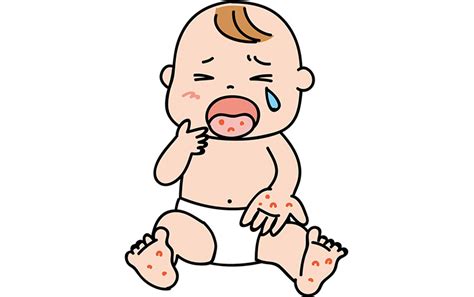 夏に流行する病気「手足口病」をご存知ですか？ | 皮膚科医の ...