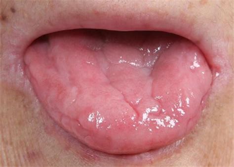 People with this condition have problems swallowing due to small, thin growths of tissue. Angular cheilitis and smooth tongue with loss of the ...