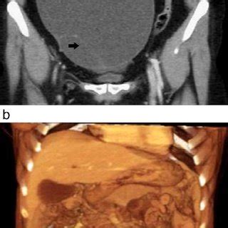 Early stage ovarian cancer does not present distinct symptoms, which is why it can grow unnoticed in the abdominal cavity area, without causing pain. FIGO staging of ovarian cancer | Download Table