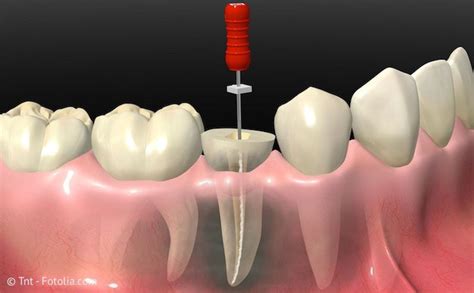 Die wurzelkanalbehandlung ist der versuch, den eigenen zahn zu erhalten. Wurzelbehandlung in Lampertheim - Dr. Gunther Becker