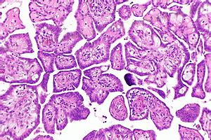 A case of abdominal discomfort caused by benign multicystic peritoneal mesothelioma. Well-differentiated papillary mesothelioma - Libre Pathology