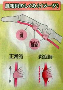 関節リュウマチ指 手 指 手指に腫れ.痛み 変形 変形性指関節症 ...
