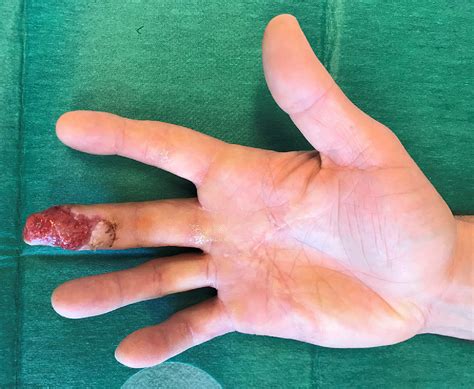 Treatment of finger degloving injury with acellular dermal matrices ...