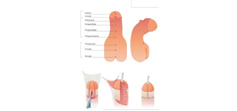 Bisa di pangkal penis, bahkan pada beberapa kasus ada di bawah skrotum. Hipospádia: quando o menino não faz xixi pela ponta do pênis