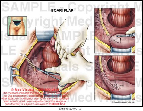 Coming out di lucilla boari dopo la conquista della medaglia di bronzo ai giochi di tokyo 2020. Boari Flap Medical Illustration Medivisuals