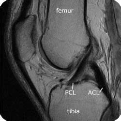 Hover on/off image to show/hide findings. Knee PCL ACL | Acl, Radiology, Med school