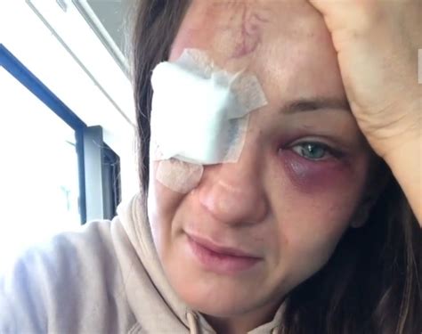 Karolina kowalkiewicz z powodzeniem przeszła operację uszkodzonego oka w jednej z warszawskich klinik. Kowalkiewicz przeszła operację oka. Lekarz powiedział, że ...