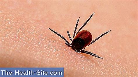 Boala lyme poate fi tratată dacă este defecționată, dar fără tratament, poate. Boala Lyme: Declanșare, Curs, Prognostic 💊 Științifico ...