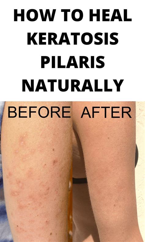 Nobody knows exactly why keratin builds up, but the condition is thought to run in families. How to heal Keratosis Pilaris from the inside out in 2020 ...