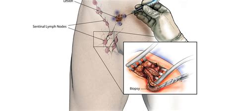 Lymph nodes also serve to trap and destroy cells from cancerous tumors. Sentinel Lymph Node Biopsy for Skin Cancer