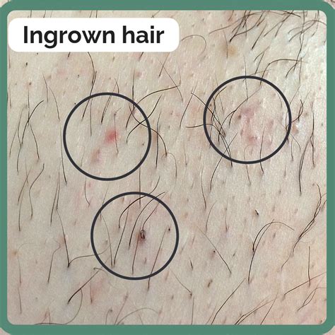 Deep ingrown hair can be difficult to remove. Those are tiny little ingrown hairs! #shaving #waxing # ...