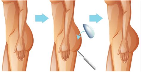 L'augmentation des fesses par implant fessier est réalisée pour l'élargissement de la région fessière et parfois pour la reconstruction. Augmentation fesses Tunisie : Prix implant fessier Tunisie