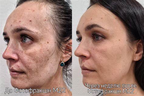 Гормональные сбои от диеты