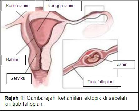 Utama » kehamilan » ketika hamil » sakit perut berterusan mungkin tanda kehamilan luar rahim. Tanda Kehamilan Ektopik Malaysia