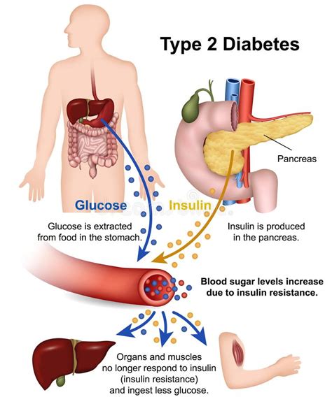 It does an essential job. Type 2 Diabetes Medical Illustration With English ...