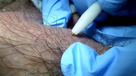 Pubic hair is a bit troublesome for some people, but it is necessary to remove a pubic hair from time to time. Hair Removal on Terminal Hair. Electrolysis. - YouTube