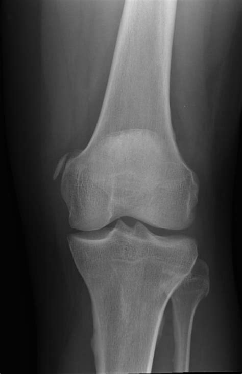 This occurs due to the deposition of calcium on the inner side of the knee. Image | Radiopaedia.org